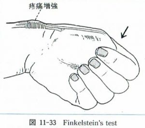 finkelstein's　test